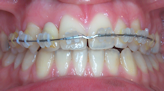 traitement orthodontie Asnieres 92