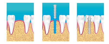 implant dentaire Asnieres Voltaire 92 