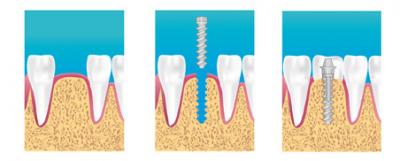 Implant dentaire Asnieres Voltaire 92 